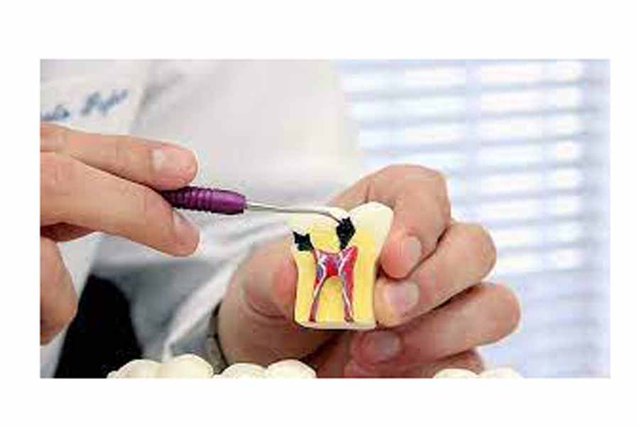 Entenda Como Feito O Tratamento De Canal Endodontia Na Diniz