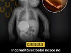 Bebê nasce com a irmã gêmea dentro do abdômen em caso raríssimo na Colômbia
