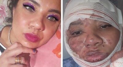 Antes e depois de vítima de queimadura (Foto: reprodução / Rádio Caçula)
