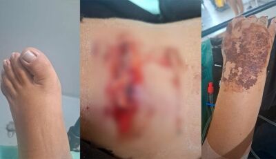 Motociclista atingida por picape fratura os dois braços e dedo do pé 
