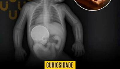 Bebê nasce com a irmã gêmea dentro do abdômen em caso raríssimo na Colômbia
