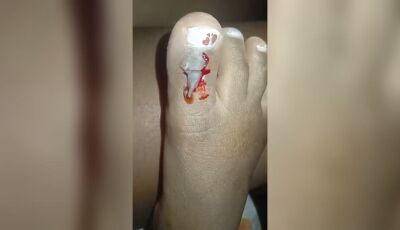 Menina de 5 anos é atacada por pitbull enquanto andava de bicicleta no Cristo Redentor