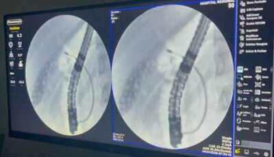 Exame inédito marca avanço da alta complexidade no Hospital Regional de Dourados