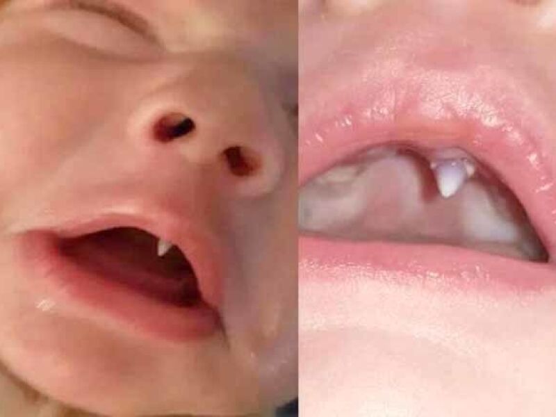 Bebê com dente de vampiro assusta mãe e médicos - Fátima News