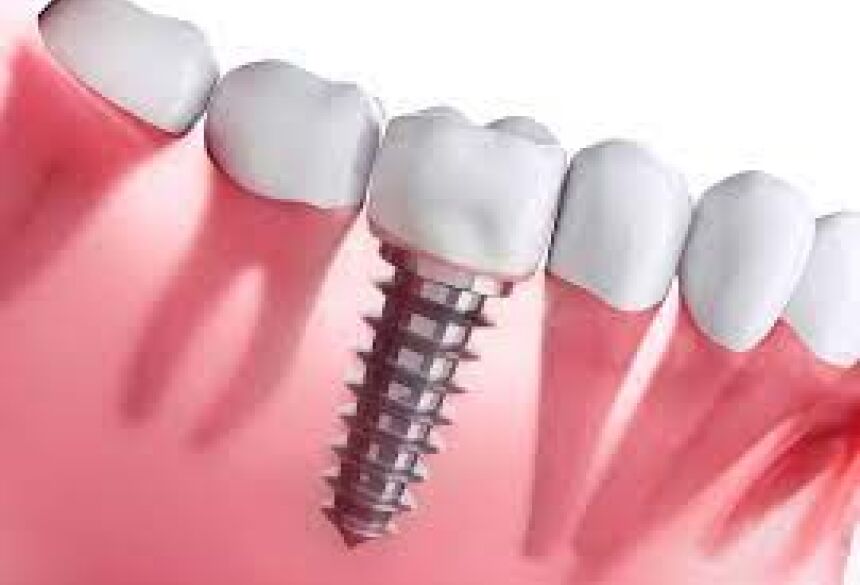 Os Implantes Dentários são a melhor escolha para quem já perdeu seus dentes naturais e deseja ter o seu seu sorriso restabelecido
