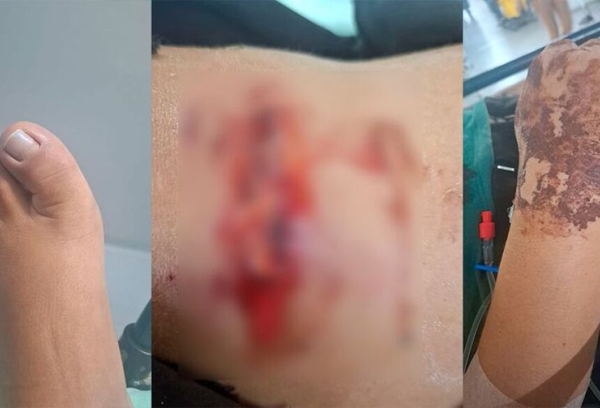 Vítima fraturou os dois braços e o dedo do pé 