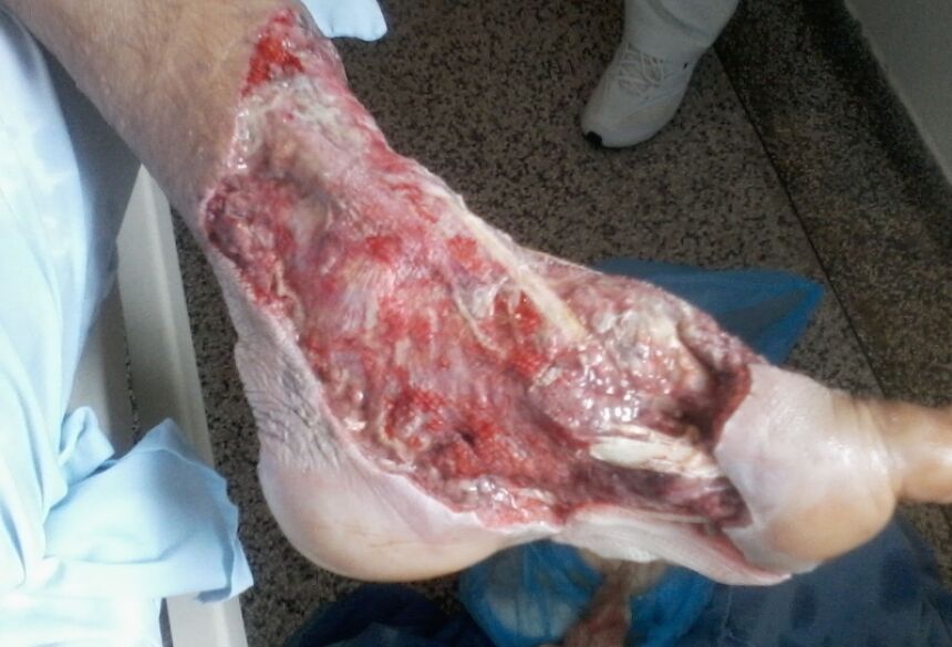Imagem do pé esquerdo lesionado foi cedido pela família do paciente