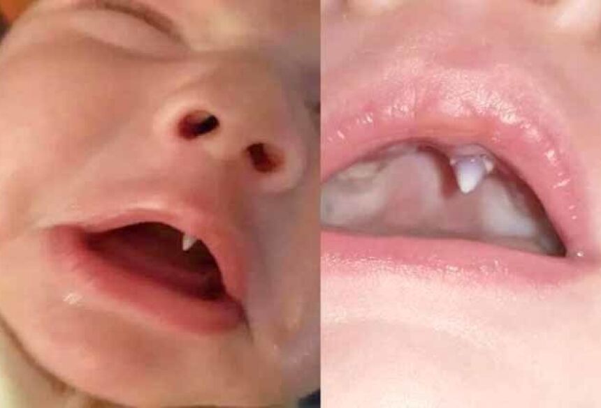 Bebê com dente chamou a atenção da mãe e de médicos. Ele tinha apenas 11 semanas quando o dente apareceu (Foto: Reprodução/Facebook)