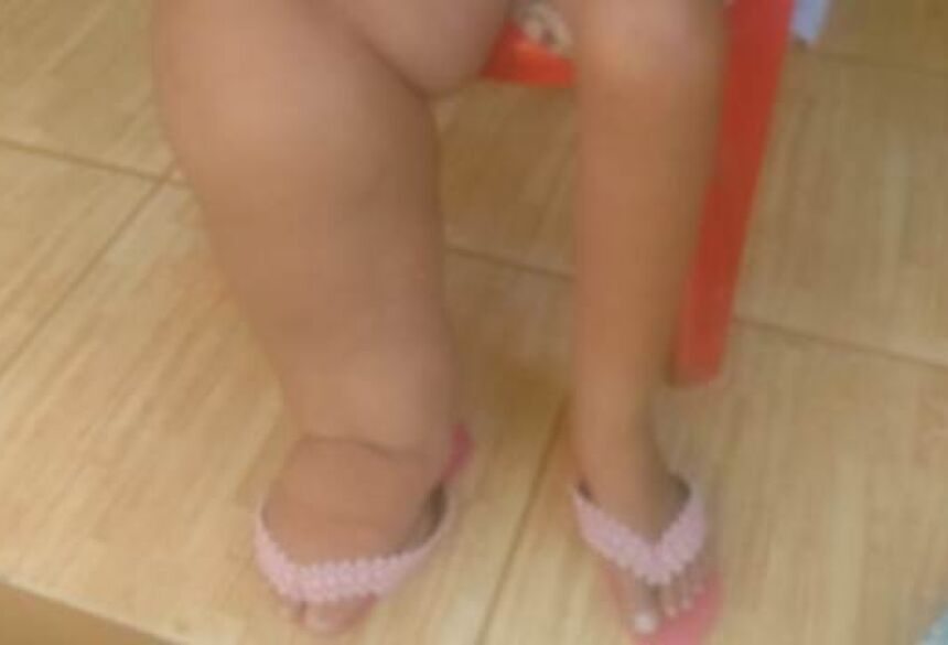 Foto da perna da jovem, autorizada pela família