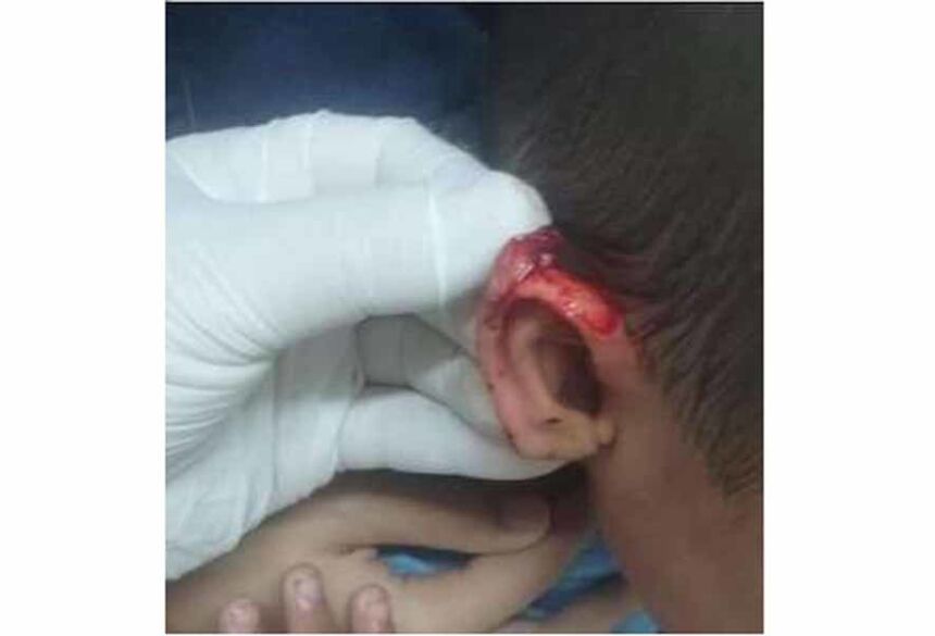 Giovana Araújo utilizou as redes sociais para alertar a população, alegando que o filho teve a orelha cortada por um coleguinha no Ceinf Neida Gordin Freire, no bairro Moreninha III