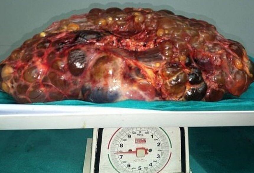 Rim de 7,4 quilos retirado de paciente indiano Foto: Reprodução