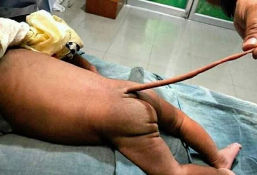Imagem de bebê que nasceu com rabo na Colombia no mês de Julho de 2019