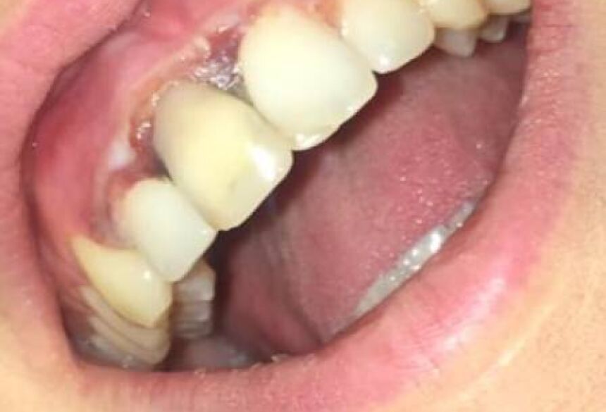 Mulher sofre queimadura em procedimento 'barato' para clarear os dentes Foto: Reprodução/Facebook(Aoife Wills)