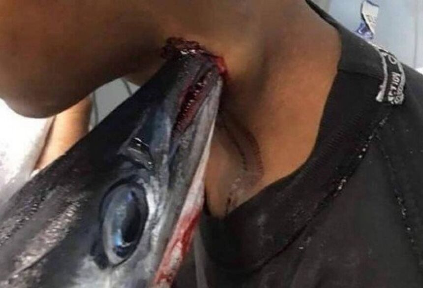 Peixe-agulha cravado no pescoço de adolescente na Indonésia Foto: Reprodução/Facebook(Savage Paramedics)