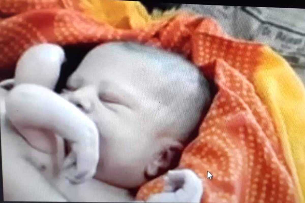 Bebê nasce com quatro braços e quatro pernas; veja as fotos - Fátima News